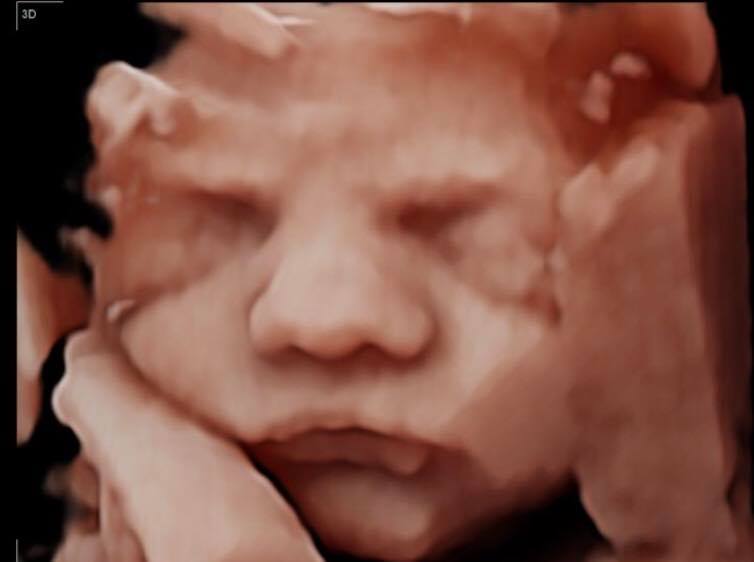 Baby with a big nose 3D ultrasound picture