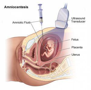 diagram of fetus in placenta that shows where the amniocentesis is injected during ultrasound