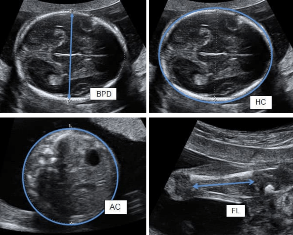 How Does The Sonographer Determine My Baby S Weight   Measurements 1024x822 