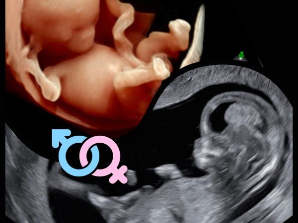 Gender (Basic/Plus) - 3D/4D/HD Ultrasound
