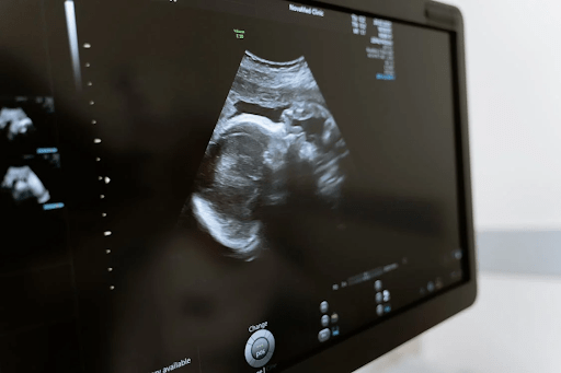 Tracking Your Baby’s Movement with Ultrasound Scan