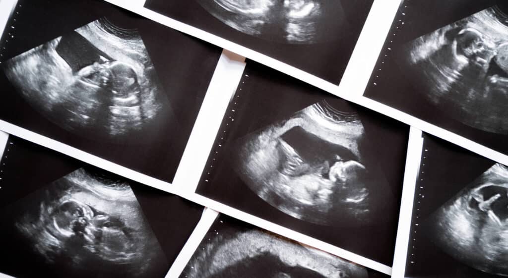 Layers of black and white ultrasound images.