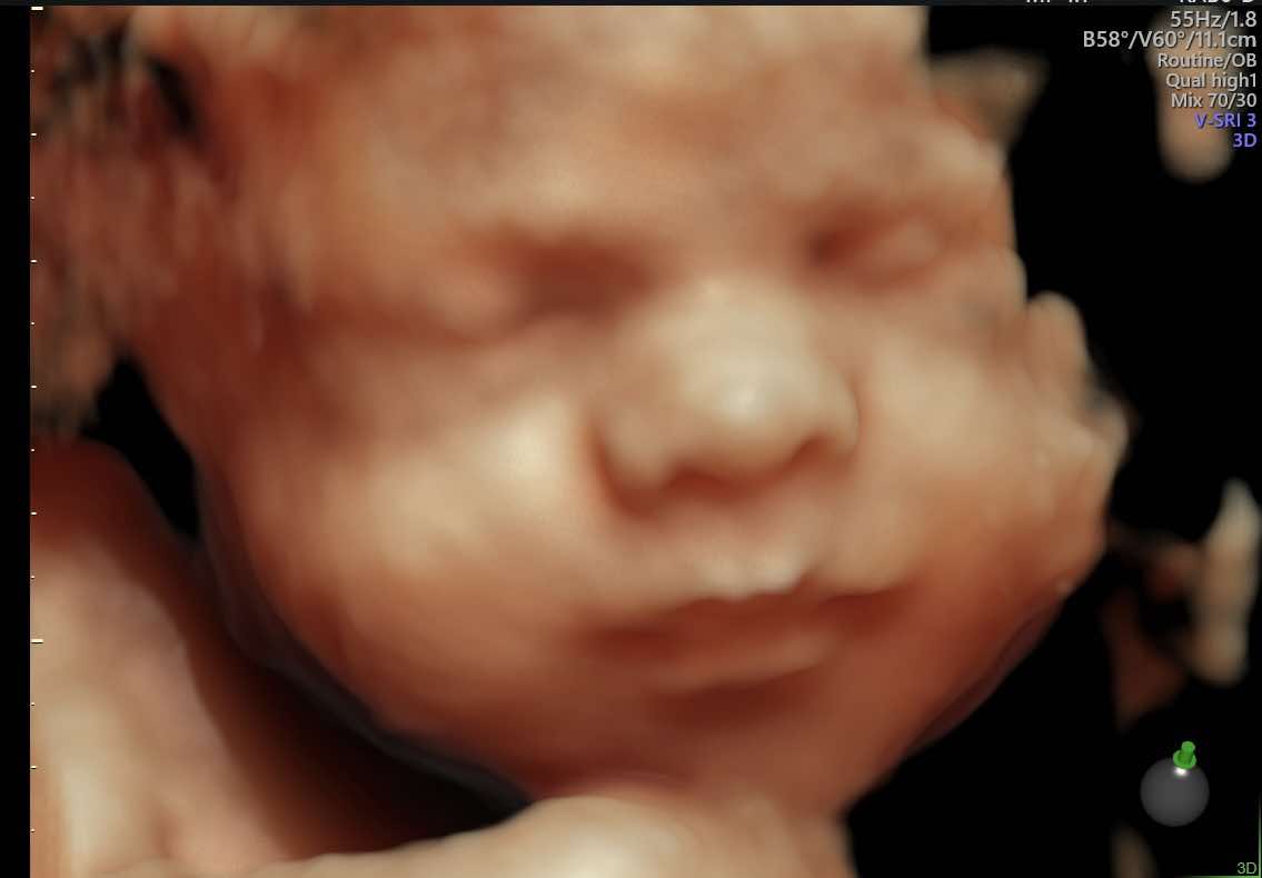 3D Ultrasound baby